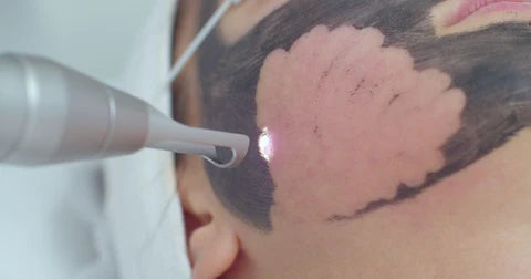 CARBON LASER PEEL FACIAL